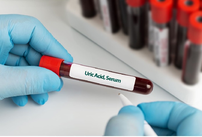 Uric Acid, Serum